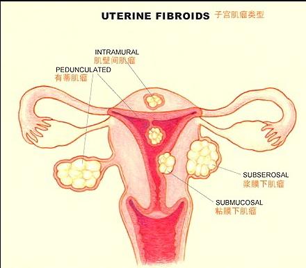 子宫肌瘤分类（阿克苏华康人流医院图示)