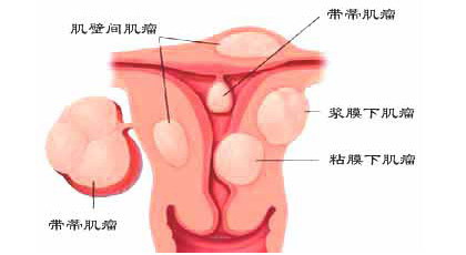 子宫肌瘤示意图