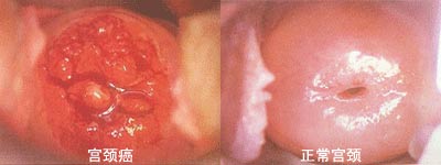 正常宫颈与宫颈癌对比图片
