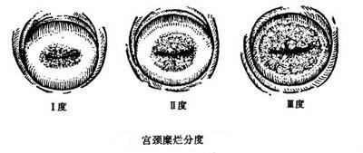 宫颈糜烂分度示意图